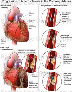 Figure 11 - Progession of plaque in coronary artery