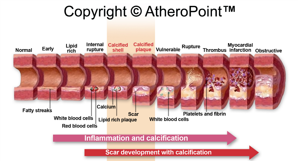 Figure 5 - Stages of progression in atherosclerosis