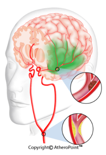 Figure 8 - Artery block leading to stroke 