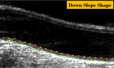 VaryingCarotidShapes_DownSlope_v2.0