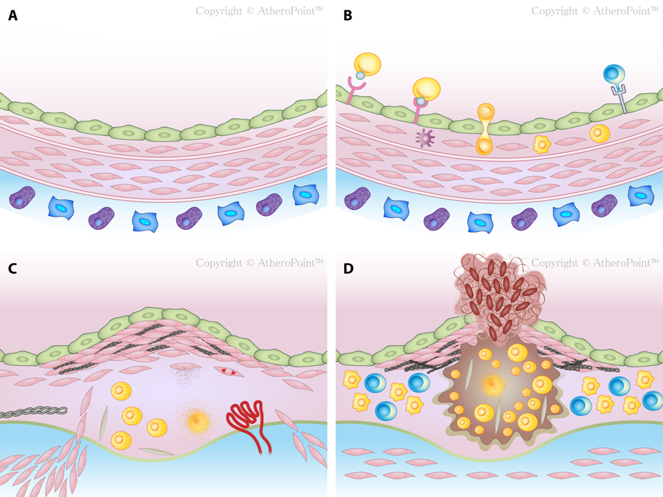 Figure 4.2 - Detailed pictorial representation of atherosclerotic lesion progression