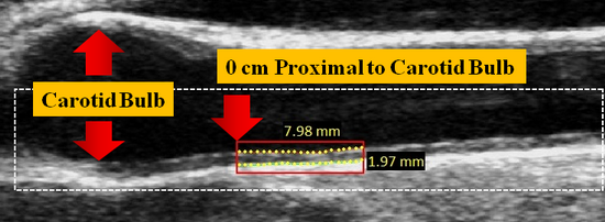 ProximalBifurcationPosition1_v5.0
