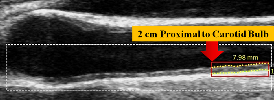 ProximalBifurcationPosition3_v4.0