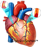 Atherosclerosis_Definition_Menu