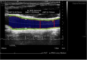 study274-cIMT-sIMT-Bulb-Overlay