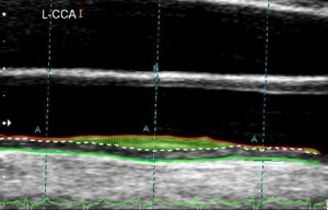 (1) JP-5LCCA-Segments-Bulb-LIMAfill-Overlay