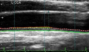 (3) JP-59LCCA-Segments-Bulb-LIMAfill-Overlay